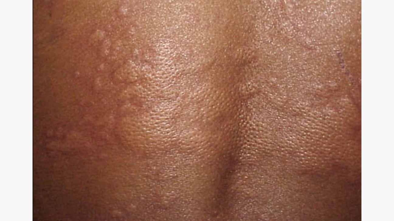 Hives (Urticaria)
